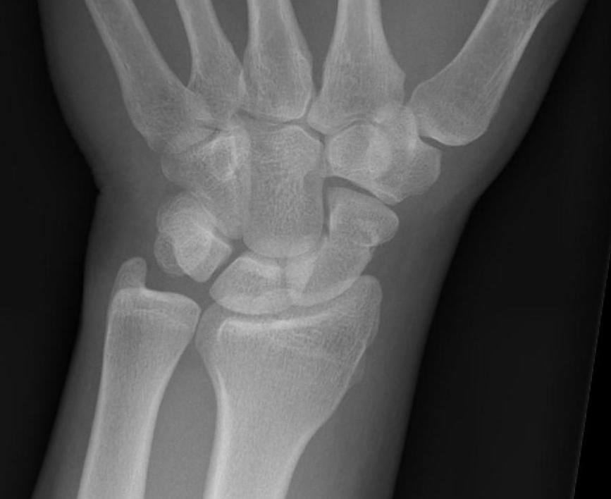 Scaphoid PA